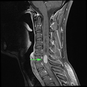 Spinal Cord Tumour