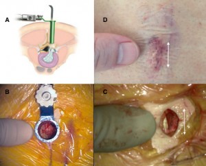 Minimally invasive keyhole microdiscectomy surgery