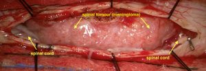 Extramedullary Spinal Cord Tumour. This image demonstrates a large tumour (meningioma) pushing on the spinal cord.