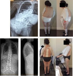 Before and After Images of Scoliosis Surgery