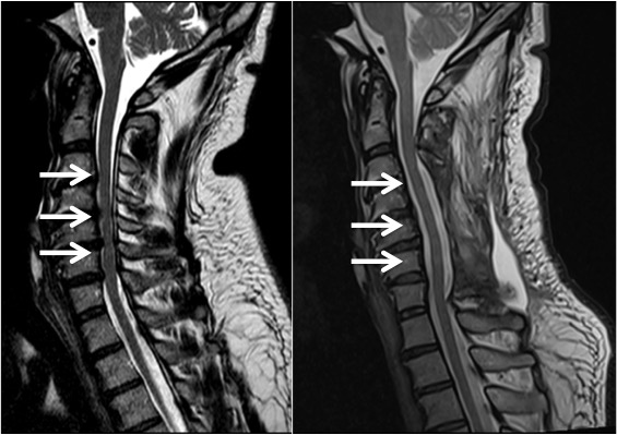 Spinal Stenosis - Sydney Neurospine